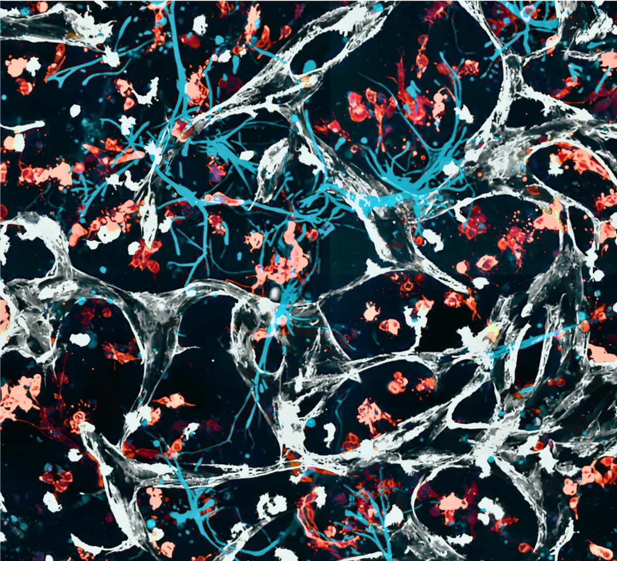 Fluorescence microscopy image of a vascularised tumor microenvironment: blood-vessel network with tumor cells